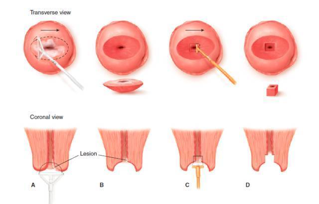 宫颈锥切术的全过程
