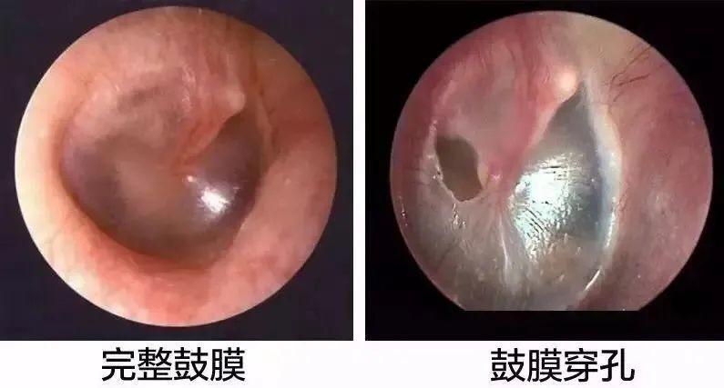耳膜穿孔后怎么保护耳朵