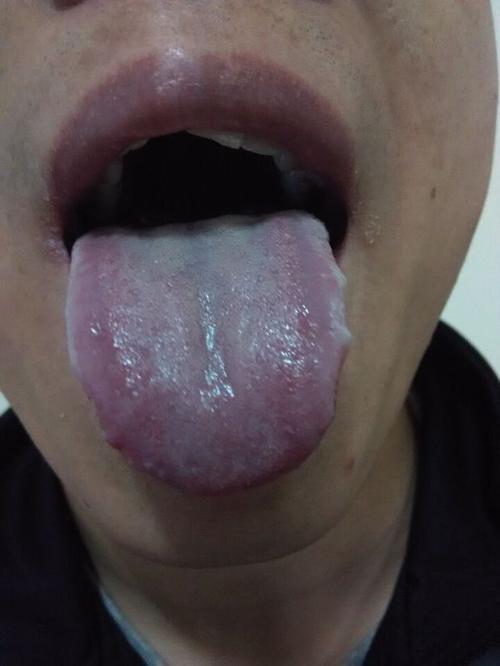 舌头有齿痕舌苔白