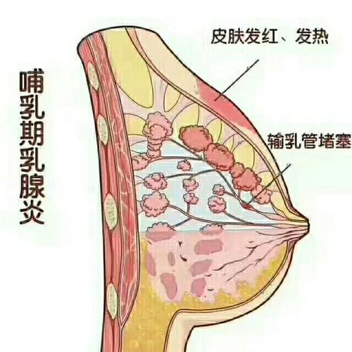哺乳期乳腺炎的相关图片