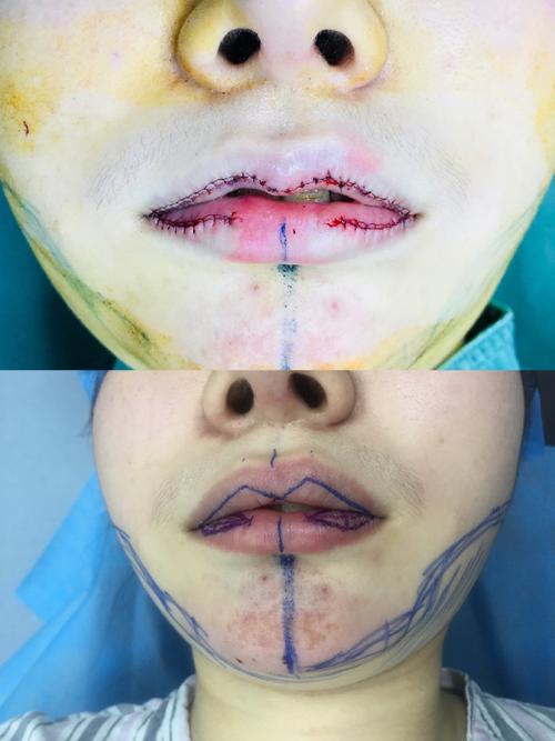 嘴唇整形手术的相关图片