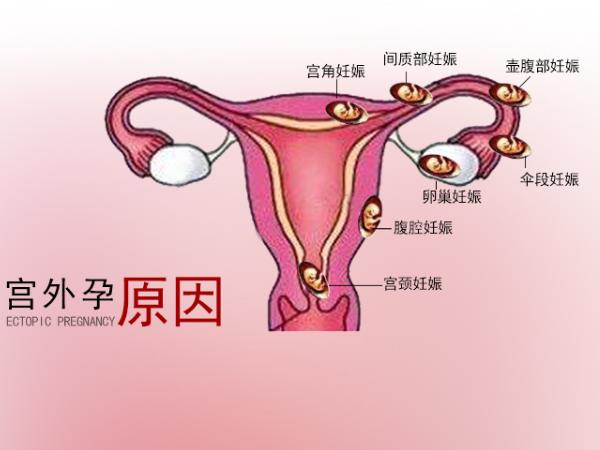 宫外孕是怎么引起的的相关图片