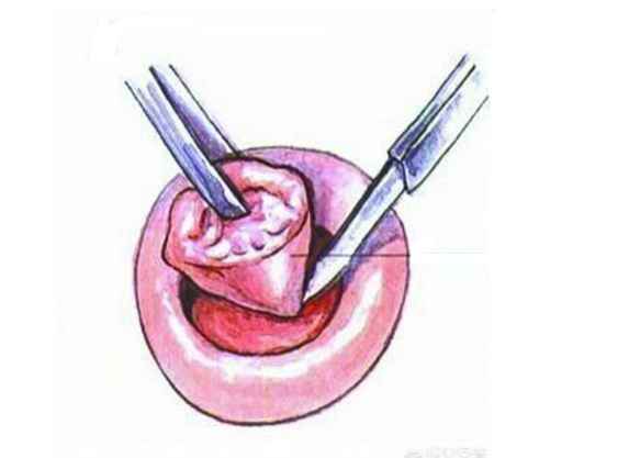 宫颈锥切术的全过程的相关图片
