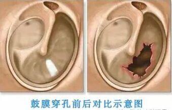 耳膜穿孔怎么办的相关图片