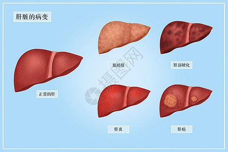 肝脏疾病的表现的相关图片