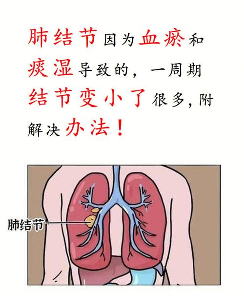 肺部结节怎么办的相关图片