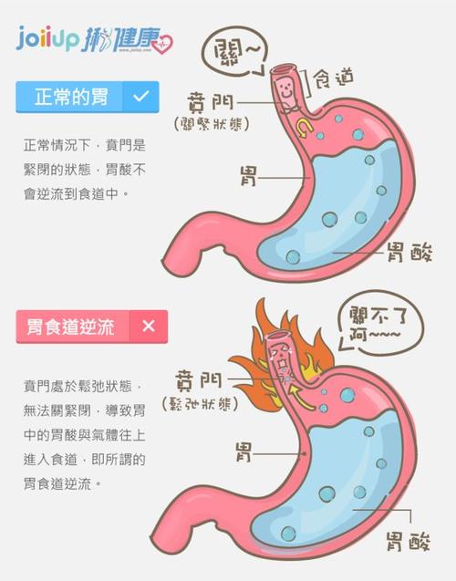胃反流是怎么回事的相关图片