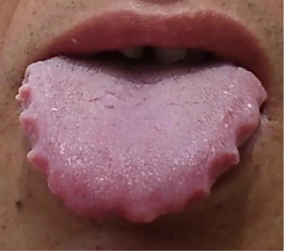 舌头有齿痕的相关图片